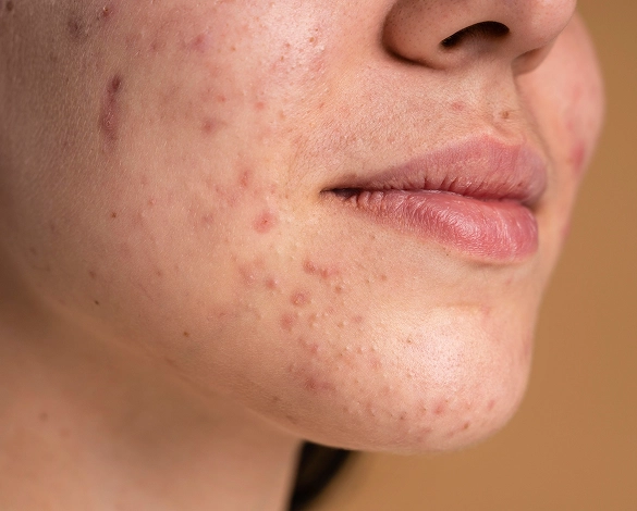 Acne-Prone Skin
